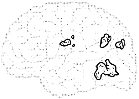 brain with very few highlighted area