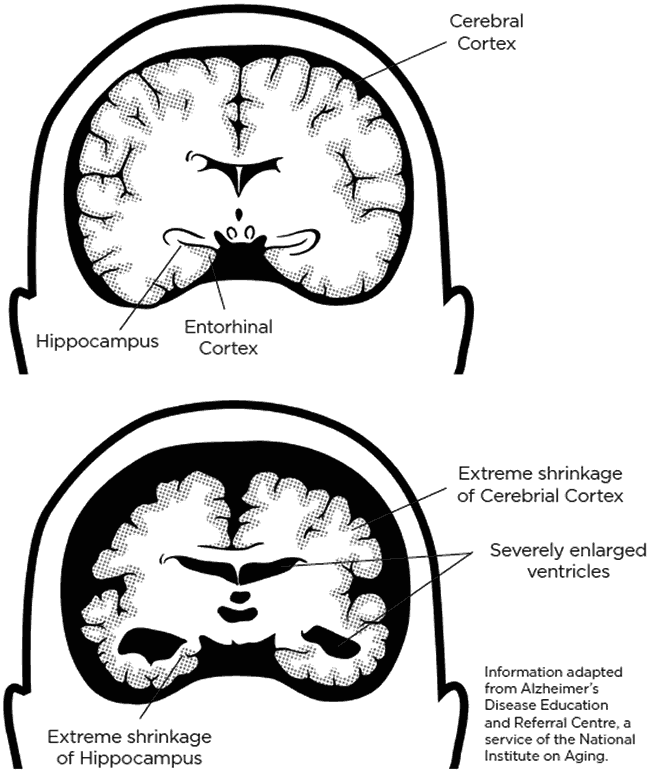 healthy brain, unhealthy smaller brain
