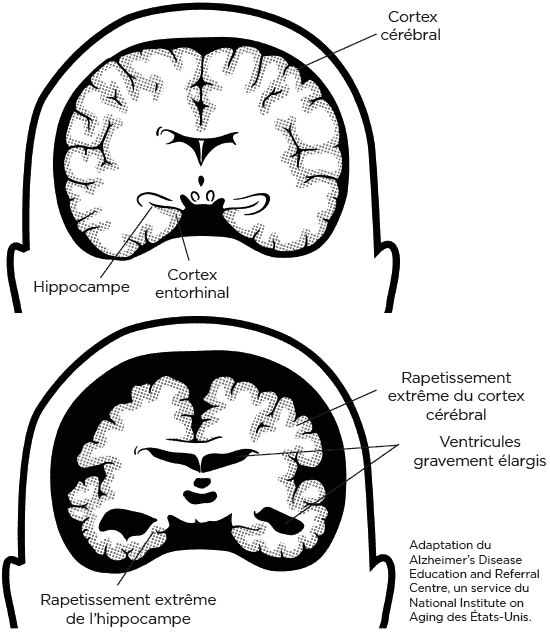 healthy brain, unhealthy smaller brain